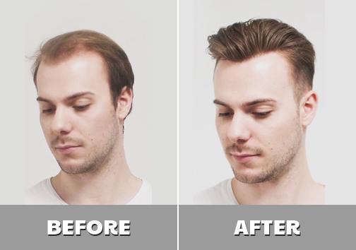 Non-Surgical Hair Transplant Center in Hyderabad