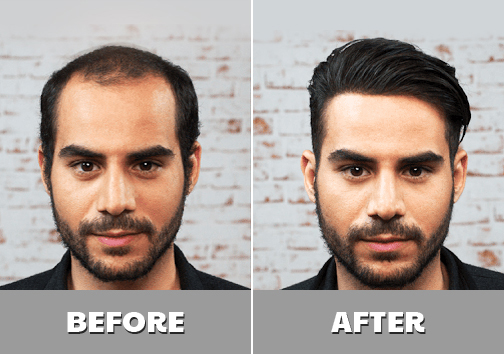 Non-Surgical Hair Transplant Center in Hyderabad